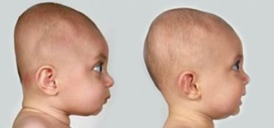 出産時と２ヶ月後の赤ちゃんの頭の形の違い｜不妊治療HP