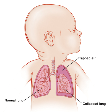 赤ちゃんの肺の解剖図｜不妊治療HP